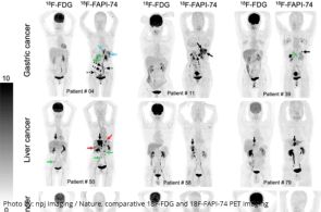 Targeting Advanced Cancer: FAPI & EphA2 PET in Germany