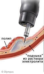 Эндоскопическая полипэктомия