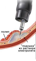 Эндоскопическая полипэктомия